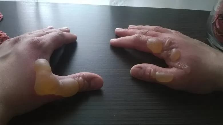 Oparzenie gazem LPG co robić: skuteczne metody leczenia i pierwsza pomoc